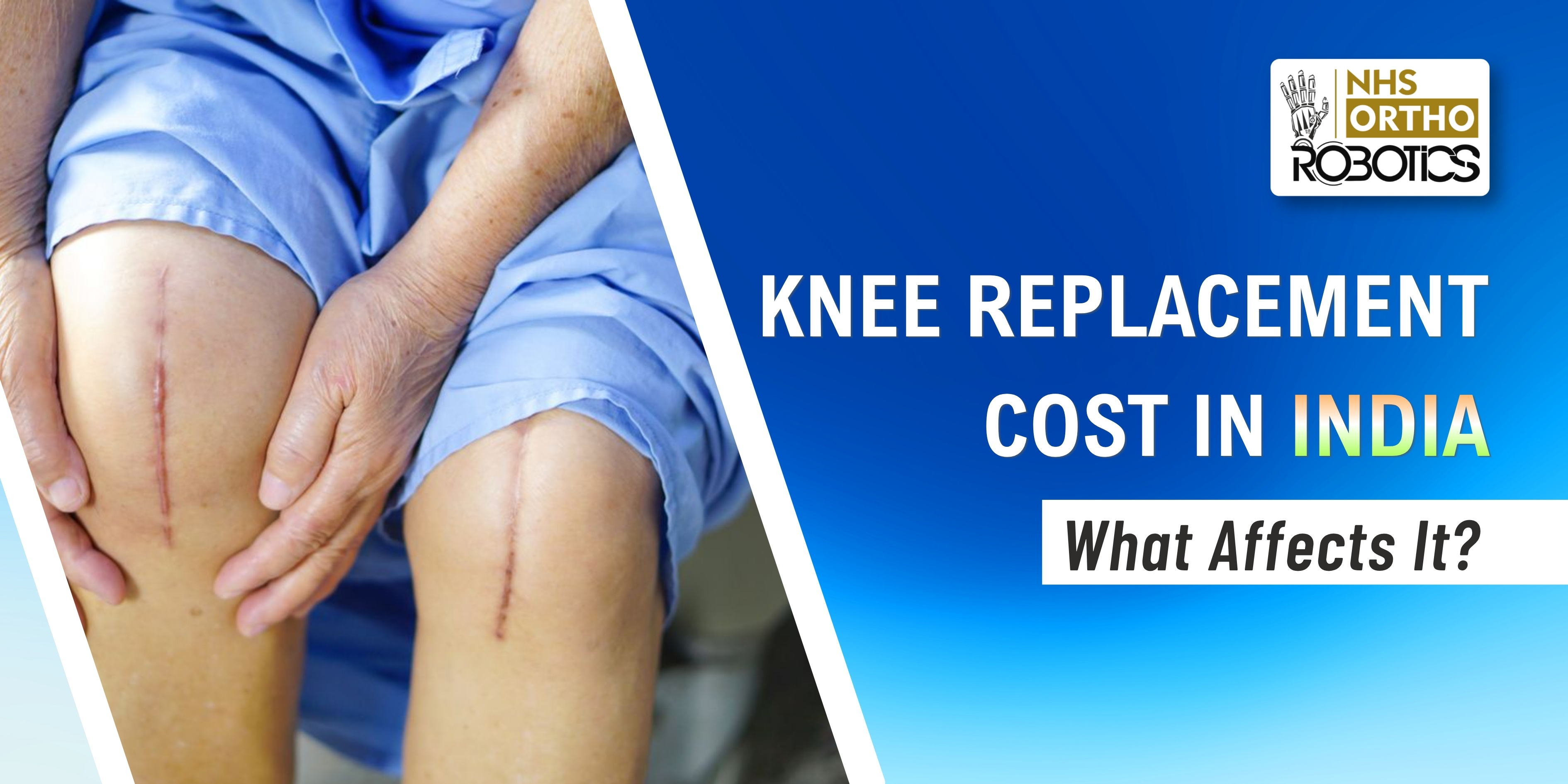 Knee Replacement Cost in India – What Affects It?